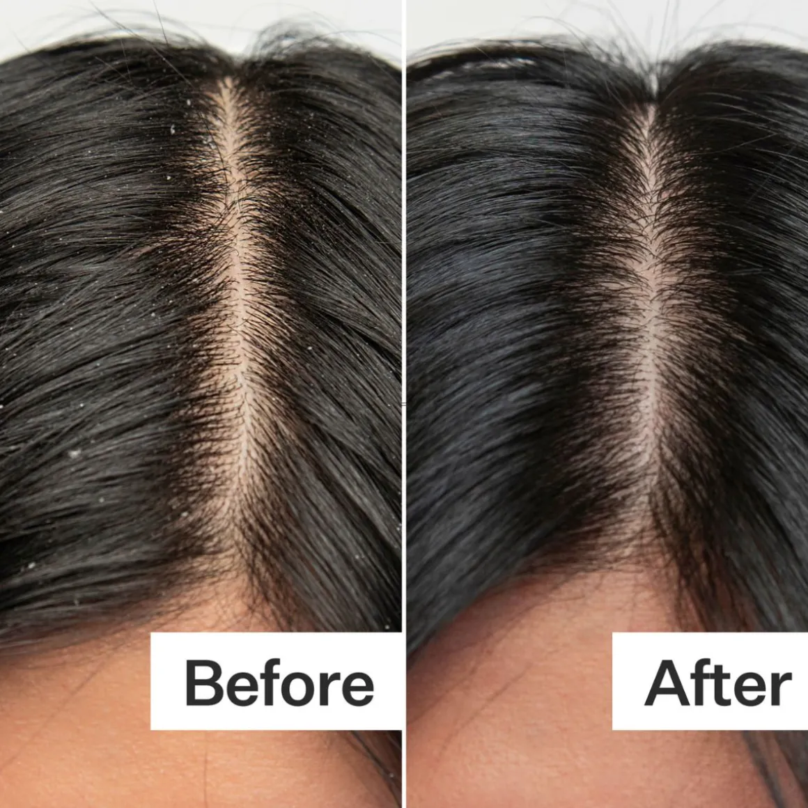 Act+Acre Dry + Itchy Scalp System