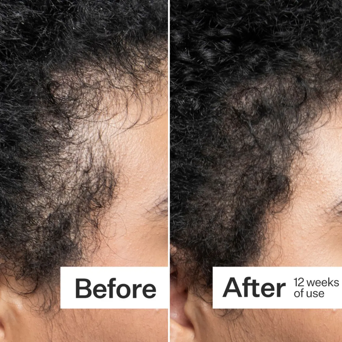Act+Acre Scalp Dermaroller 0.25mm
