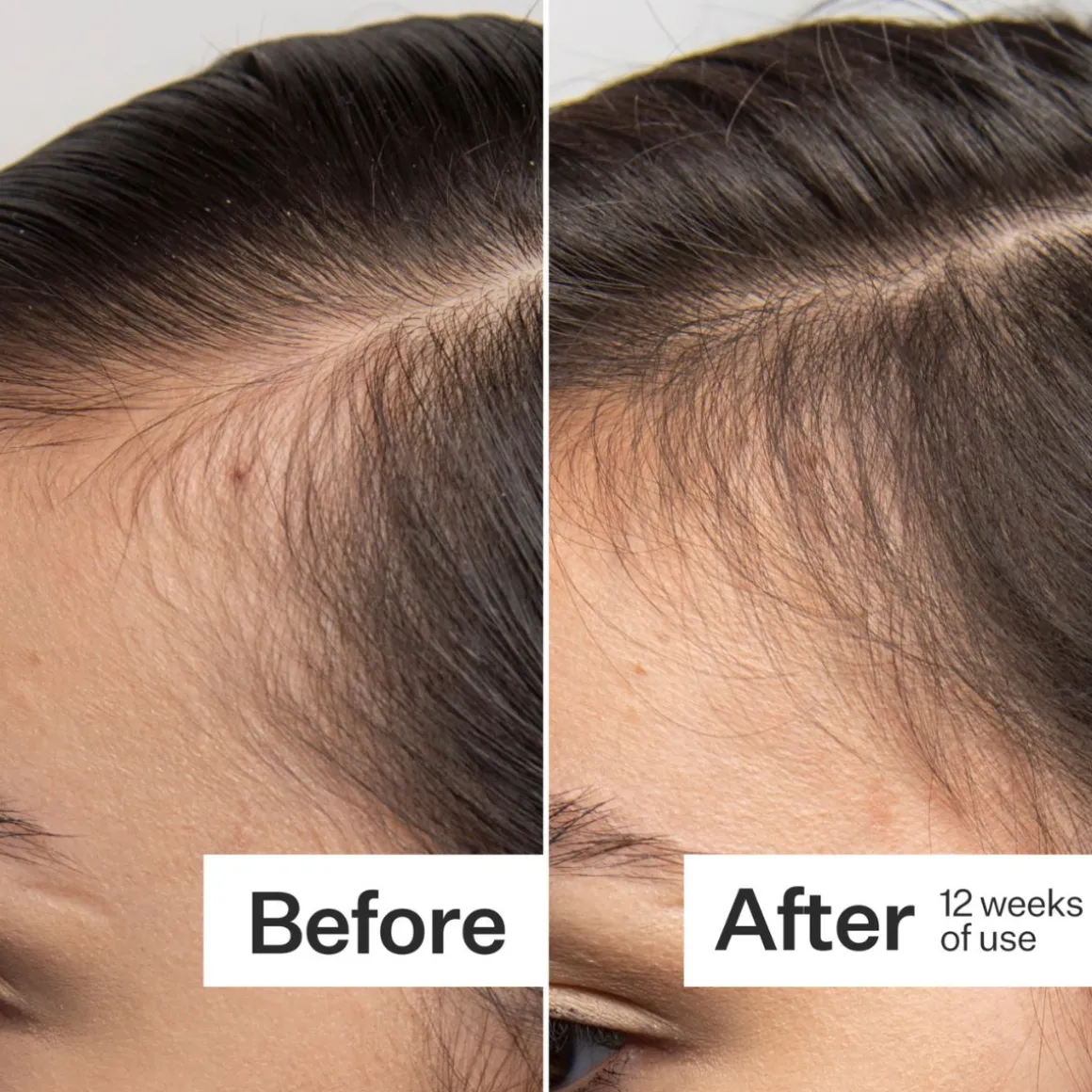 Act+Acre Scalp Dermaroller 0.25mm