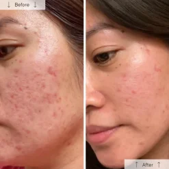 OMNILUX Clear LED Face Mask