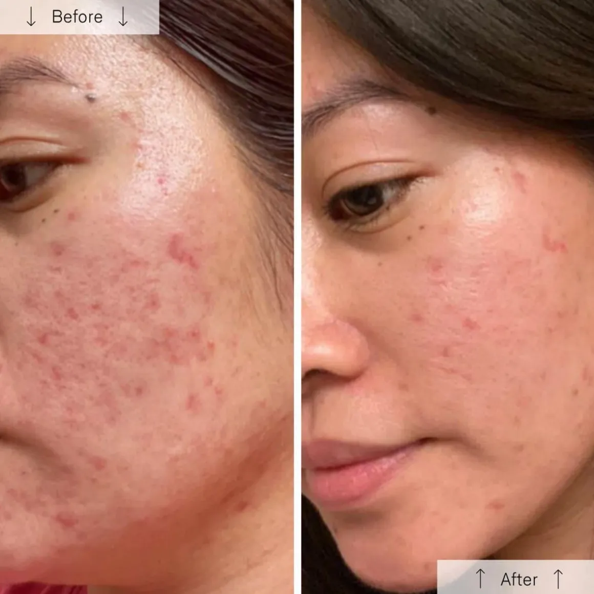 OMNILUX Clear LED Face Mask