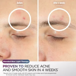 Pre-Order Shark CryoGlow Under-Eye Cooling & LED Anti-Ageing & Blemish Repair Mask Lilac Chill