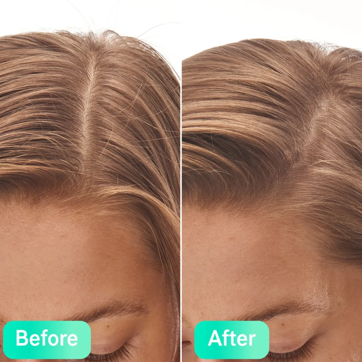 The Inkey List Salicylic Acid Exfoliating Scalp Treatment